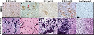 Contribution of S100A4-expressing fibroblasts to anti-SSA/Ro-associated atrioventricular nodal calcification and soluble S100A4 as a biomarker of clinical severity